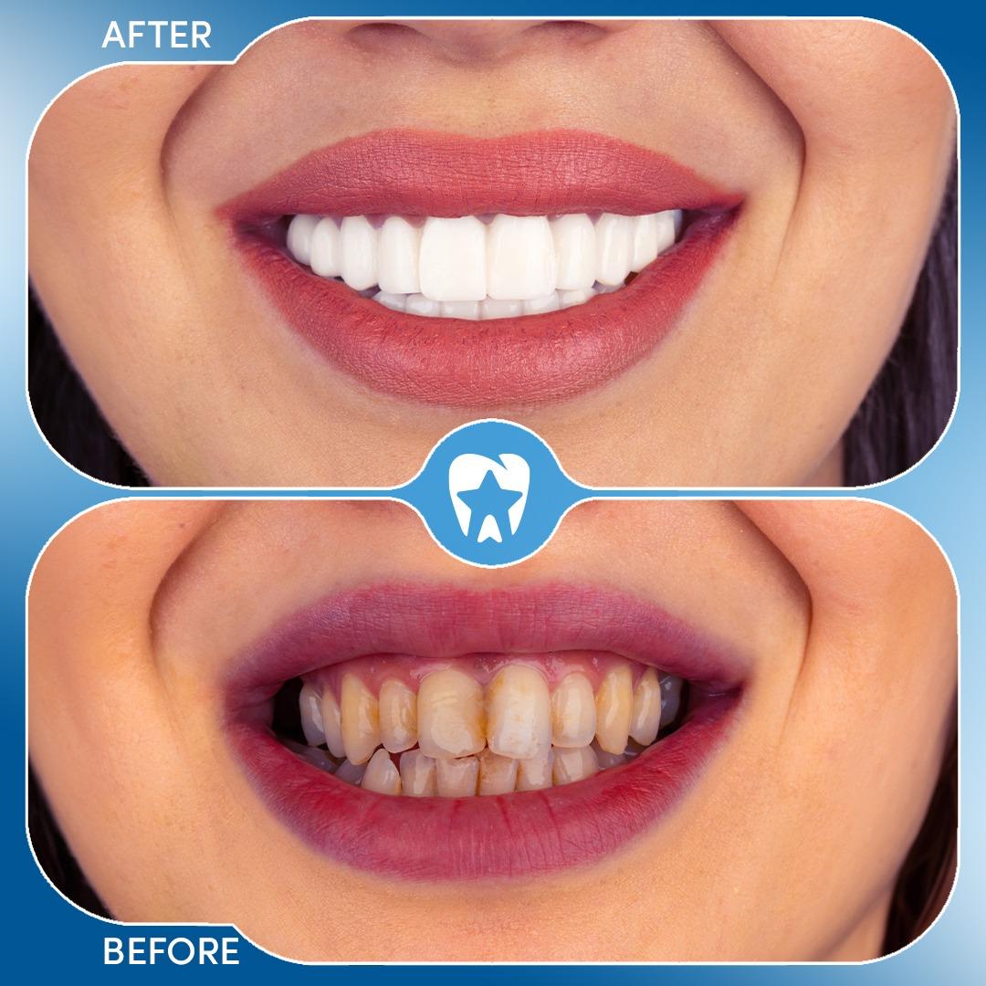Full Mouth Implants (24 Implants) before and after